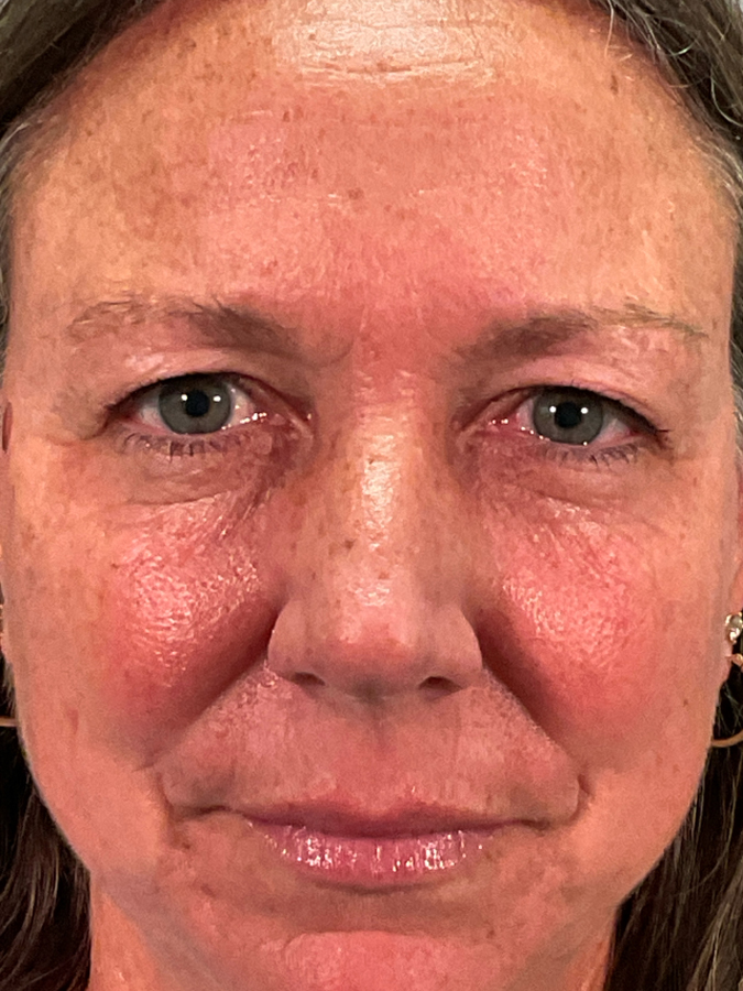 Eyelid Lift Before - Ft. Myers FL Eyelid Lift Before - Ft. Myers FL