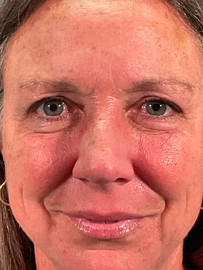 Eyelid Lift After - Ft. Myers FL Eyelid Lift After - Ft. Myers FL