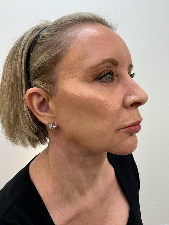 Facelift Before - Ft. Myers FL Facelift Before - Ft. Myers FL