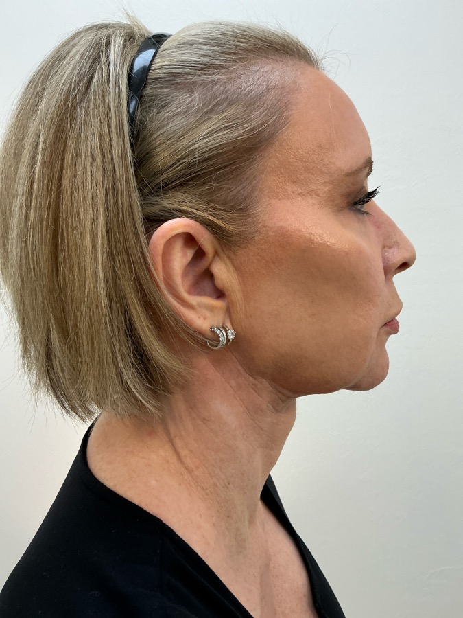 Facelift Before - Ft. Myers FL Facelift Before - Ft. Myers FL