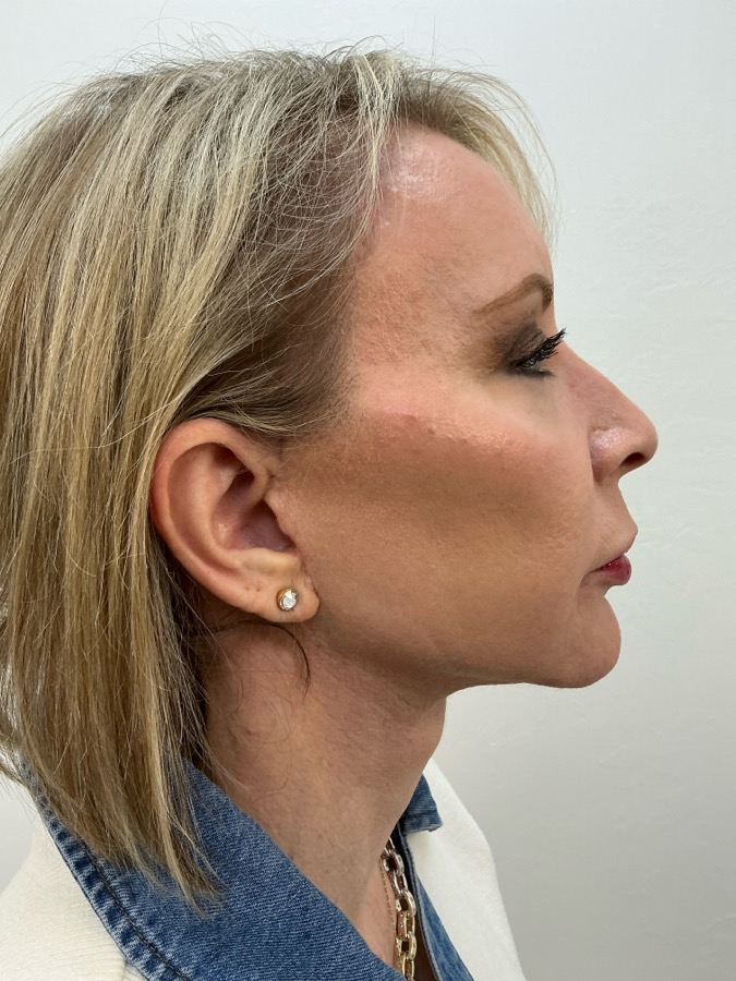 Facelift After- Ft. Myers FL Facelift After- Ft. Myers FL