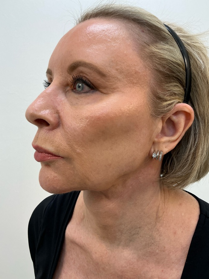Facelift Before - Ft. Myers FL Facelift Before - Ft. Myers FL