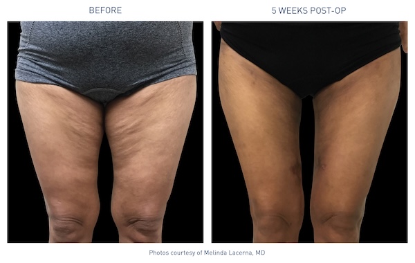 Renuvion® Before and After - Ft. Myers FL Renuvion® Before and After - Ft. Myers FL