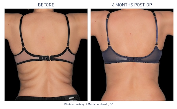 Renuvion® Before and After - Ft. Myers FL