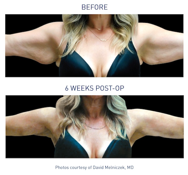 Renuvion® Before and After - Ft. Myers FL