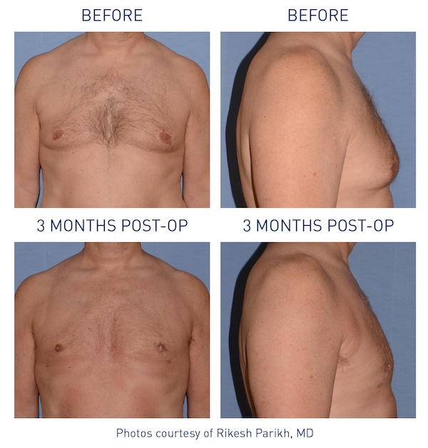 Renuvion® Before and After - Ft. Myers FL