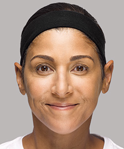 Restylane® Lyft After - Ft. Myers FL