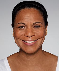 Restylane® Refyne & Defyne After - Ft. Myers FL