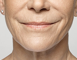 Restylane® Silk Before - Ft. Myers FL Restylane® Silk Before - Ft. Myers FL