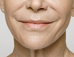 Restylane® Silk After - Ft. Myers FL Restylane® Silk After - Ft. Myers FL