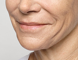 Restylane® Silk After - Ft. Myers FL Restylane® Silk After - Ft. Myers FL