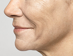 Restylane® Silk After - Ft. Myers FL Restylane® Silk After - Ft. Myers FL