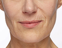 Restylane® Silk Before - Ft. Myers FL Restylane® Silk Before - Ft. Myers FL