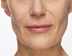 Restylane® Silk After - Ft. Myers FL Restylane® Silk After - Ft. Myers FL