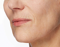 Restylane® Silk Before - Ft. Myers FL Restylane® Silk Before - Ft. Myers FL