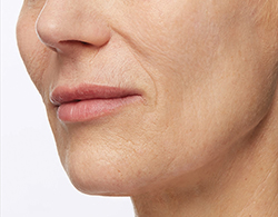 Restylane® Silk After - Ft. Myers FL Restylane® Silk After - Ft. Myers FL