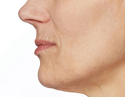 Restylane® Silk Before - Ft. Myers FL Restylane® Silk Before - Ft. Myers FL