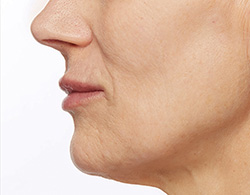 Restylane® Silk After - Ft. Myers FL Restylane® Silk After - Ft. Myers FL