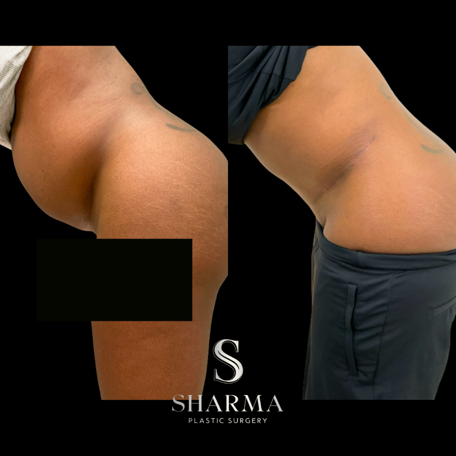 Tummy Tuck Before and After - Ft. Myers FL Tummy Tuck Before and After - Ft. Myers FL