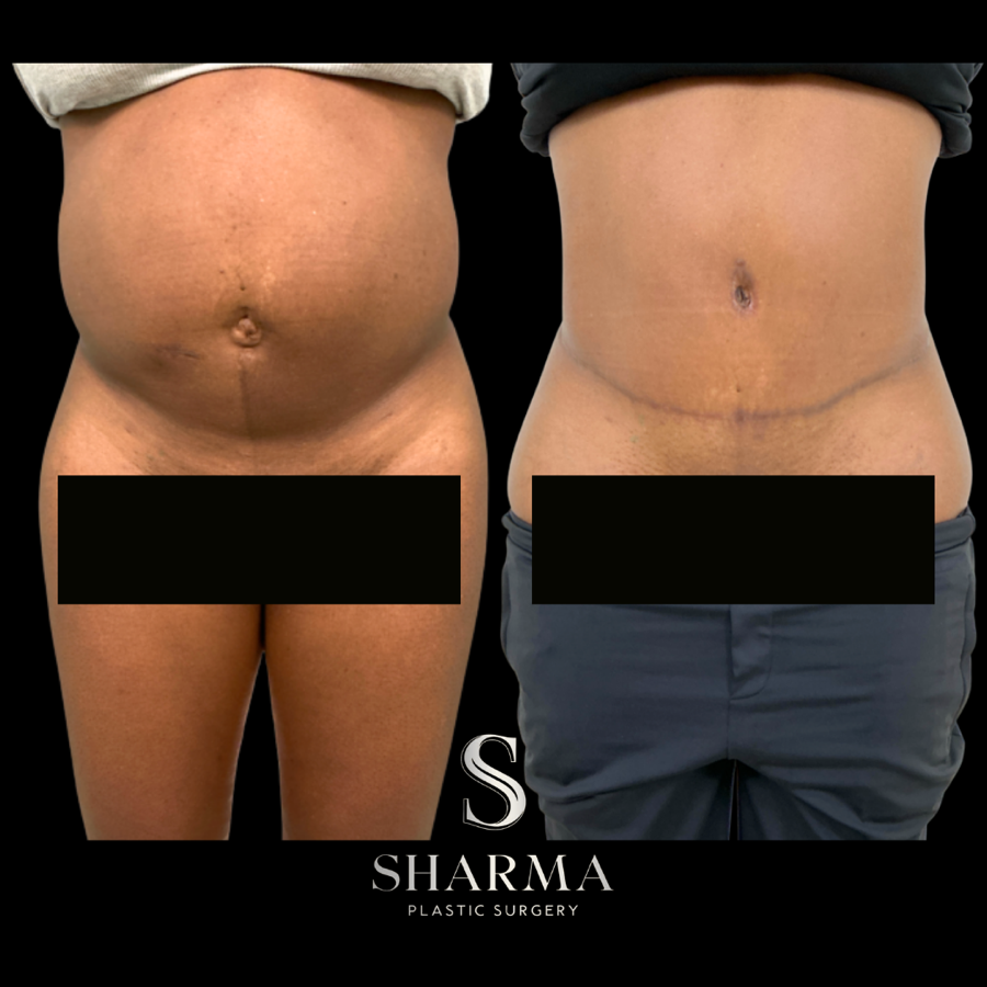 Tummy Tuck Before and After - Ft. Myers FL Tummy Tuck Before and After - Ft. Myers FL