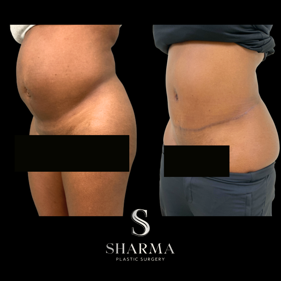 Tummy Tuck Before and After - Ft. Myers FL Tummy Tuck Before and After - Ft. Myers FL