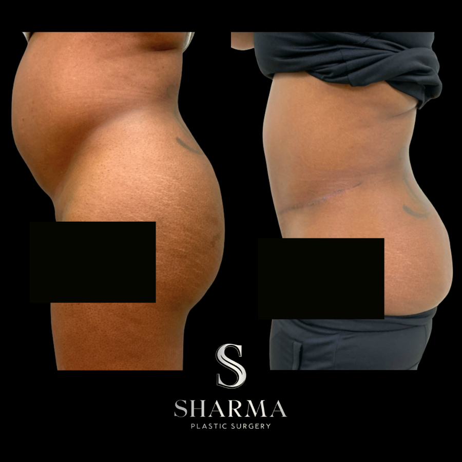 Tummy Tuck Before and After - Ft. Myers FL Tummy Tuck Before and After - Ft. Myers FL