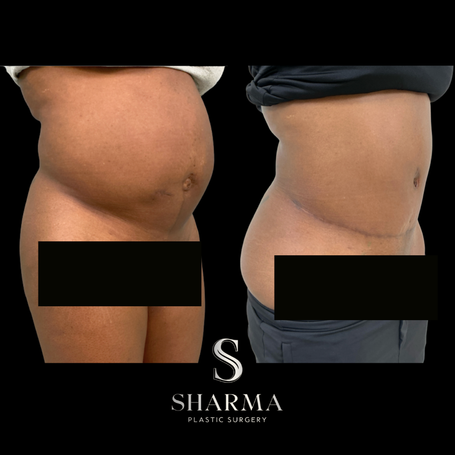 Tummy Tuck Before and After - Ft. Myers FL Tummy Tuck Before and After - Ft. Myers FL