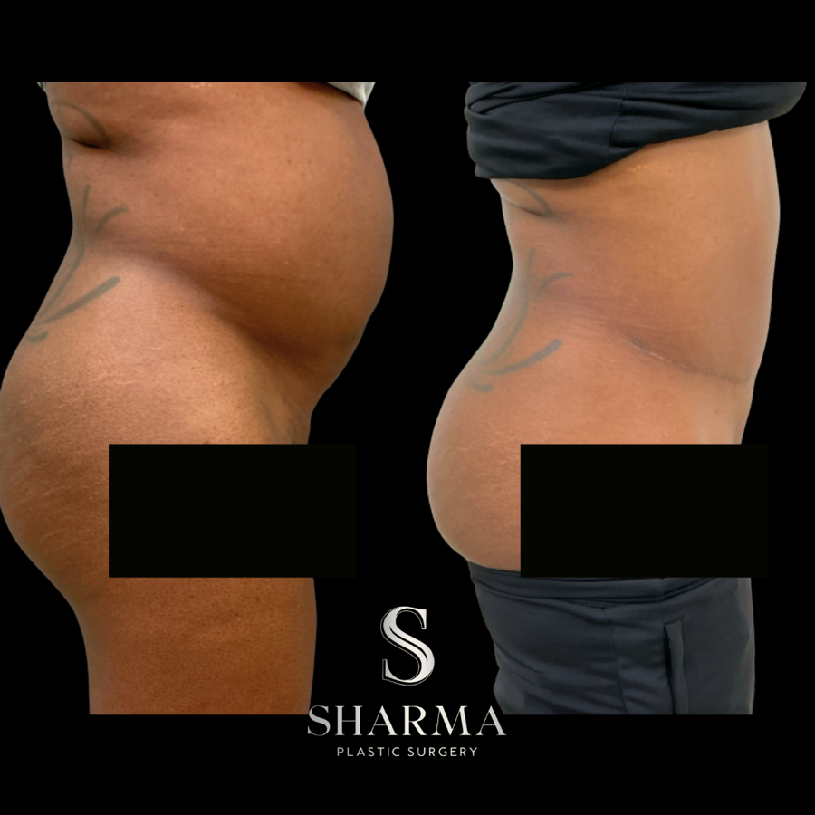 Tummy Tuck Before and After - Ft. Myers FL Tummy Tuck Before and After - Ft. Myers FL